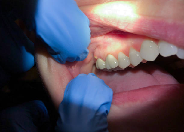 Best Emergency Dental Care for Abscessed Tooth in New Braunfels, TX